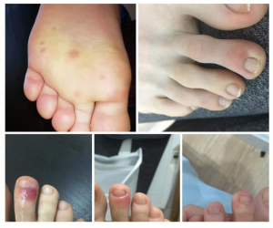 Sintomatología en los pies en enfermos de COVID-19.